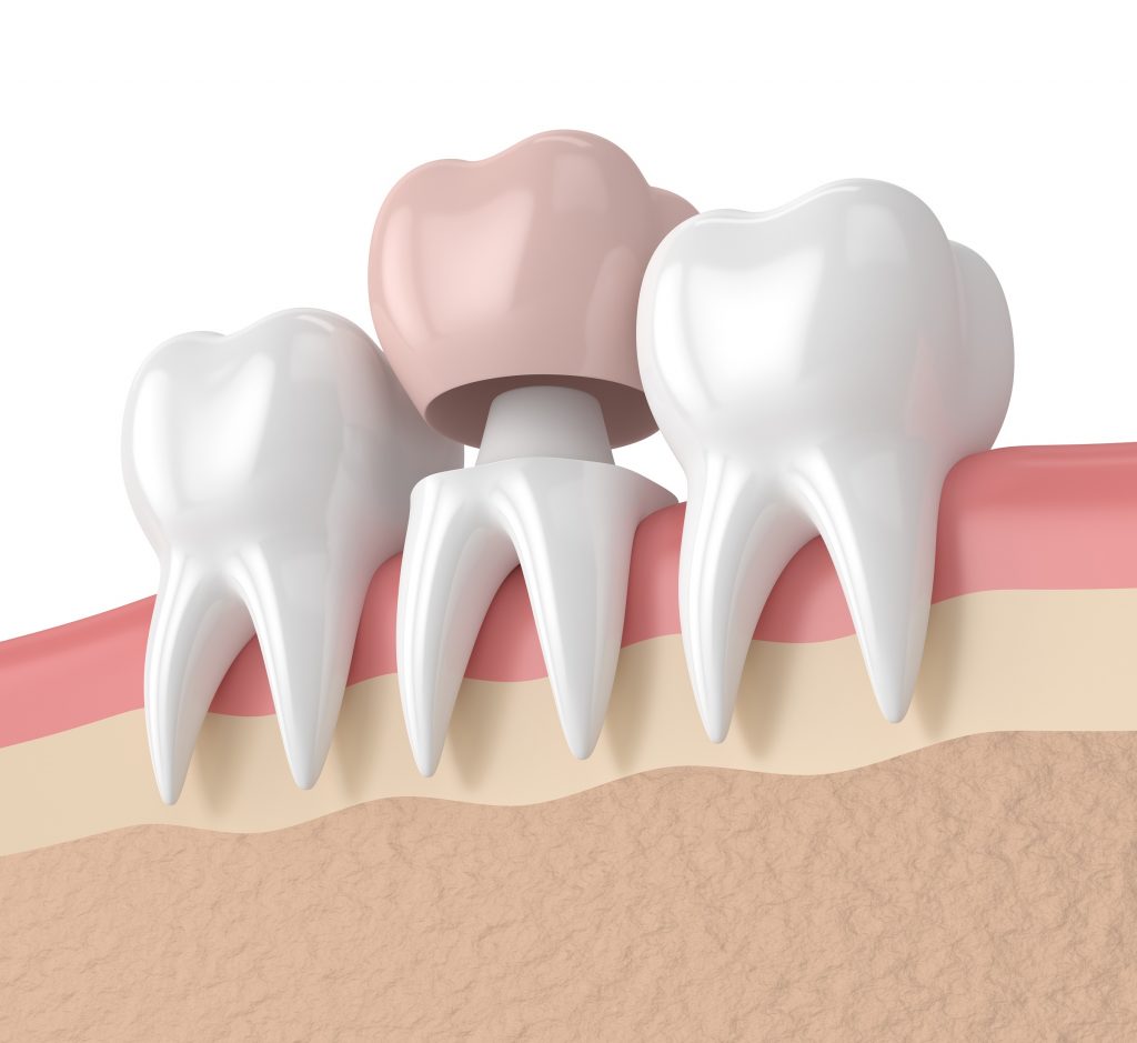 prothèse fixe amovible dentiste montesson