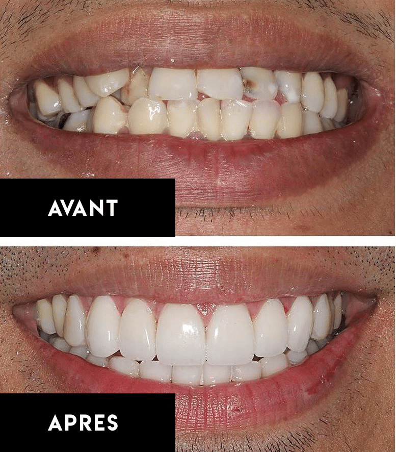 avant-apres-facettes-esthetique-dentaire