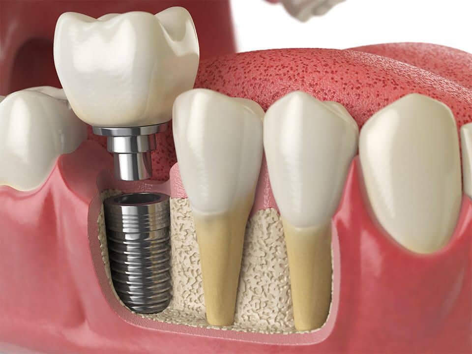 pose-implant-esthétique-dentaire-montesson